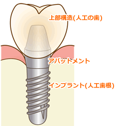 インプラントの構造