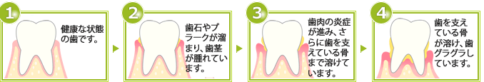 1歯垢がたまる、歯肉に炎症　2歯周ポケット、歯石　3歯槽骨の破壊　4血や濃がでる