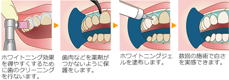 オフィスホワイトニングの手順